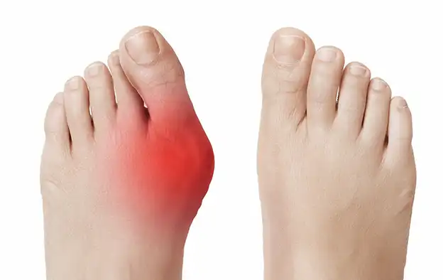 Hallux valgus