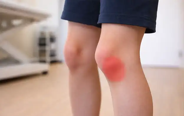 Kniepijn bij kinderen: osgood schlatter